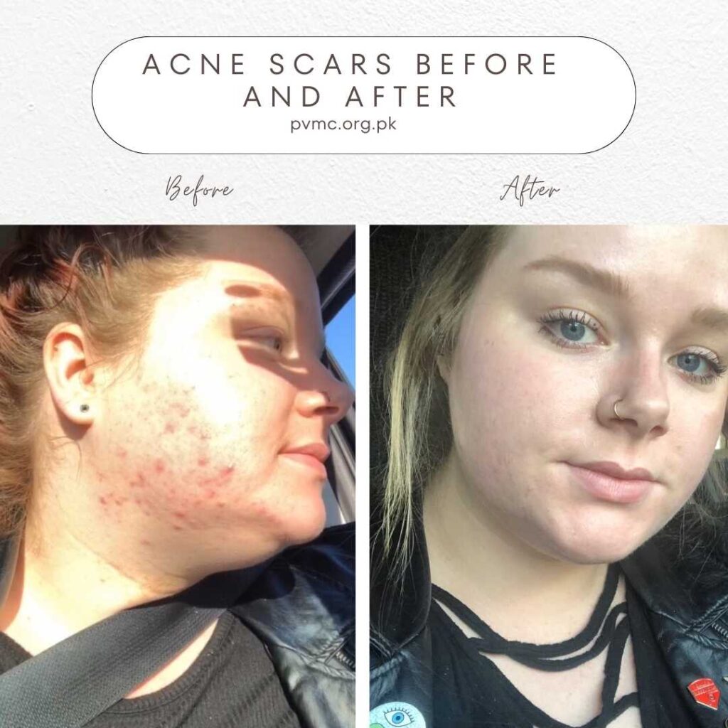 spironolactone acne before and after