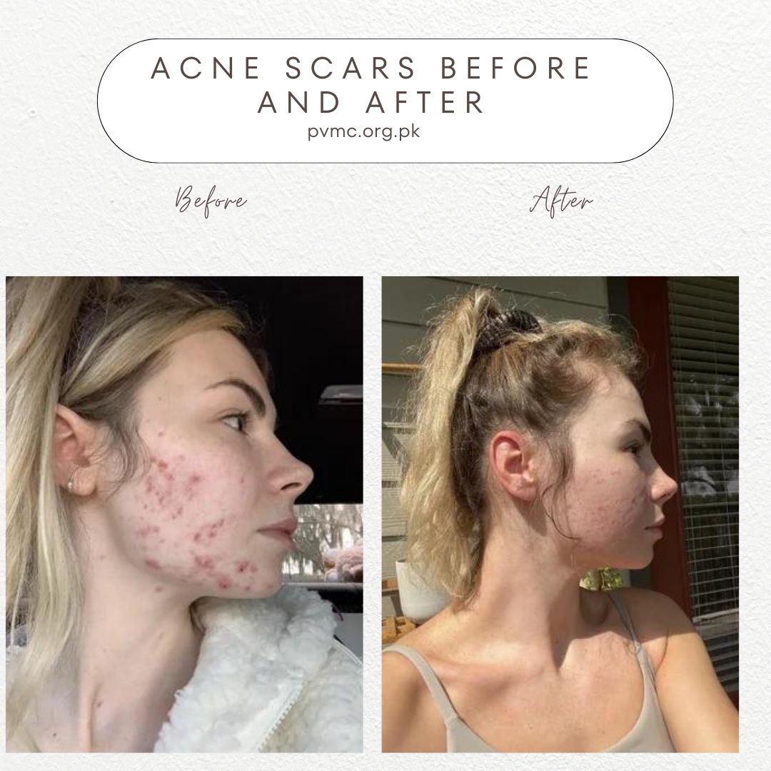 Acne Scars Before and After, a Radiant Transformation