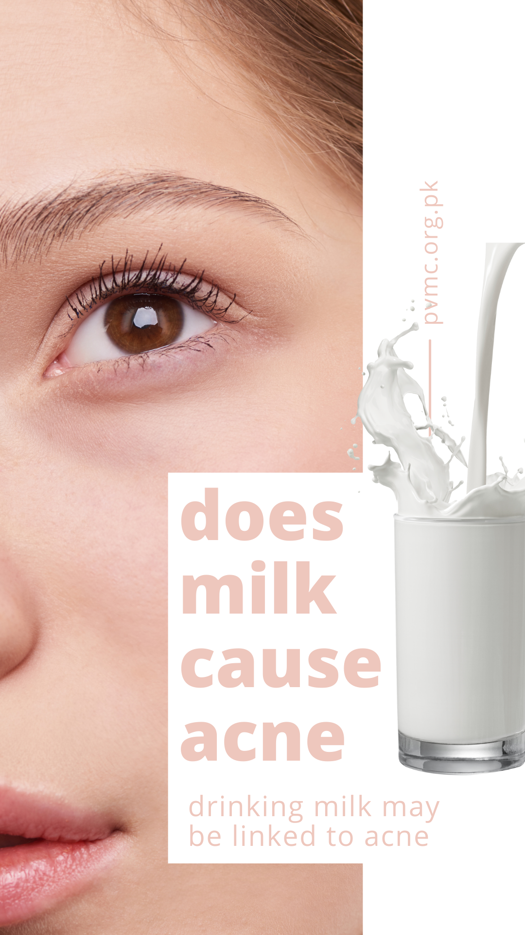 Does milk cause acne | dairy can cause acne? – Skin Acne